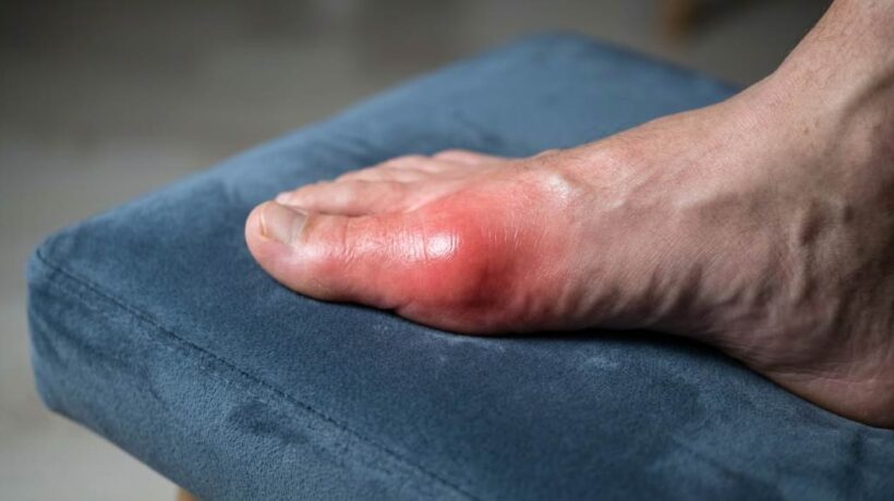 How to Reduce Foot Pain From Gout in Houston, TX